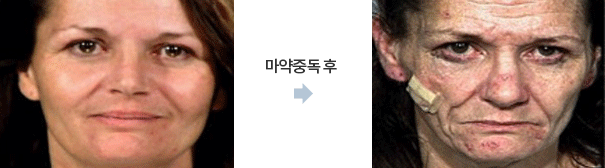 마약중독후의변화.png